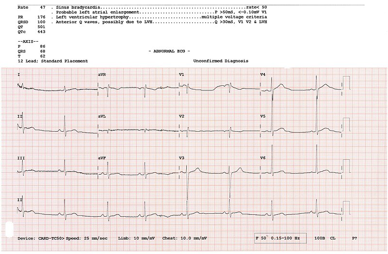 File:12 lead ECG.jpg