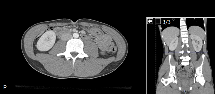 CT of a normal abdomen and pelvis, axial plane 144.png