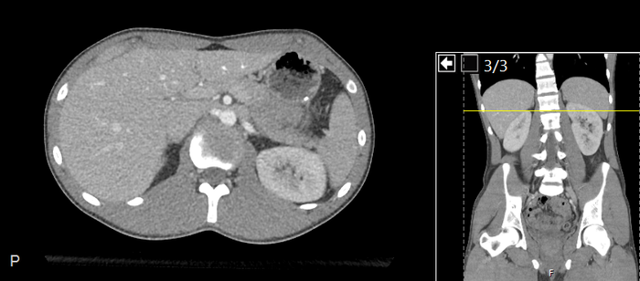 CT of a normal abdomen and pelvis, axial plane 81.png