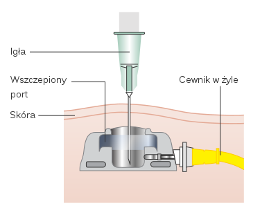 File:Diagram showing an implantable port under the skin CRUK 100 pl.svg