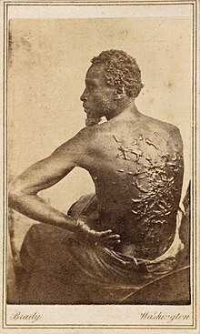 Fugitive slave Gordon during his 1863 medical examination in a U.S. Army camp. Gordon, scourged back, NPG, 1863.jpg