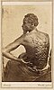 Medical examination photo of Gordon showing his scourged back, widely distributed by Abolitionists to expose the brutality of slavery