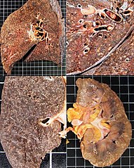 Gross pathology of the lung, spleen and kidney, showing micronodules (1–4 mm in diameter) which resemble millet seeds