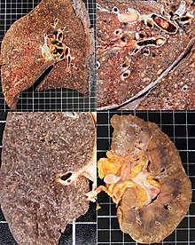 Gross pathology of miliary tuberculosis. Gross pathology of miliary tuberculosis.jpg