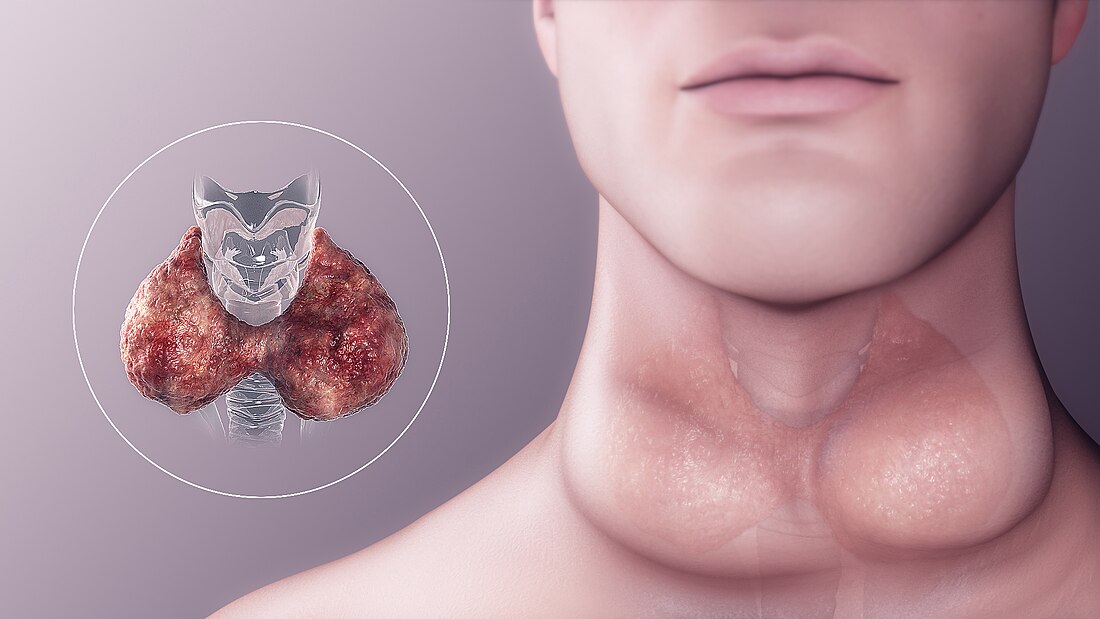 File:Hypothyroidism.jpg