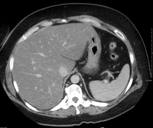 Liver steatosis (fatty liver disease) as seen on CT Liversteatosis.png