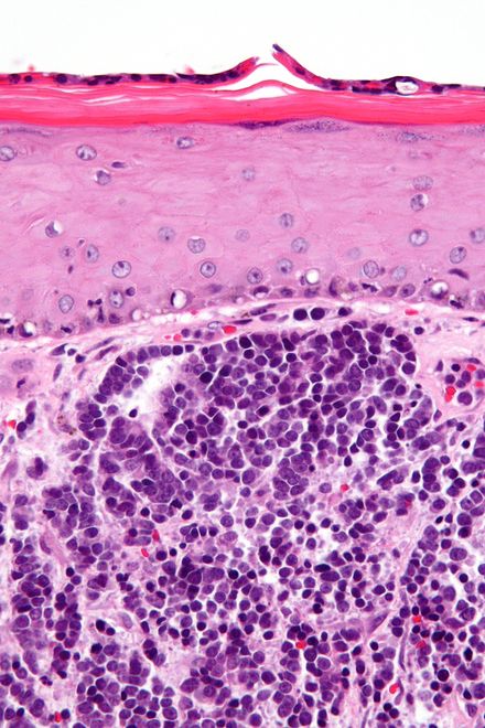 Micrograph of a Merkel cell carcinoma. H&E stain.