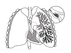 Pulmonary-embolism.png