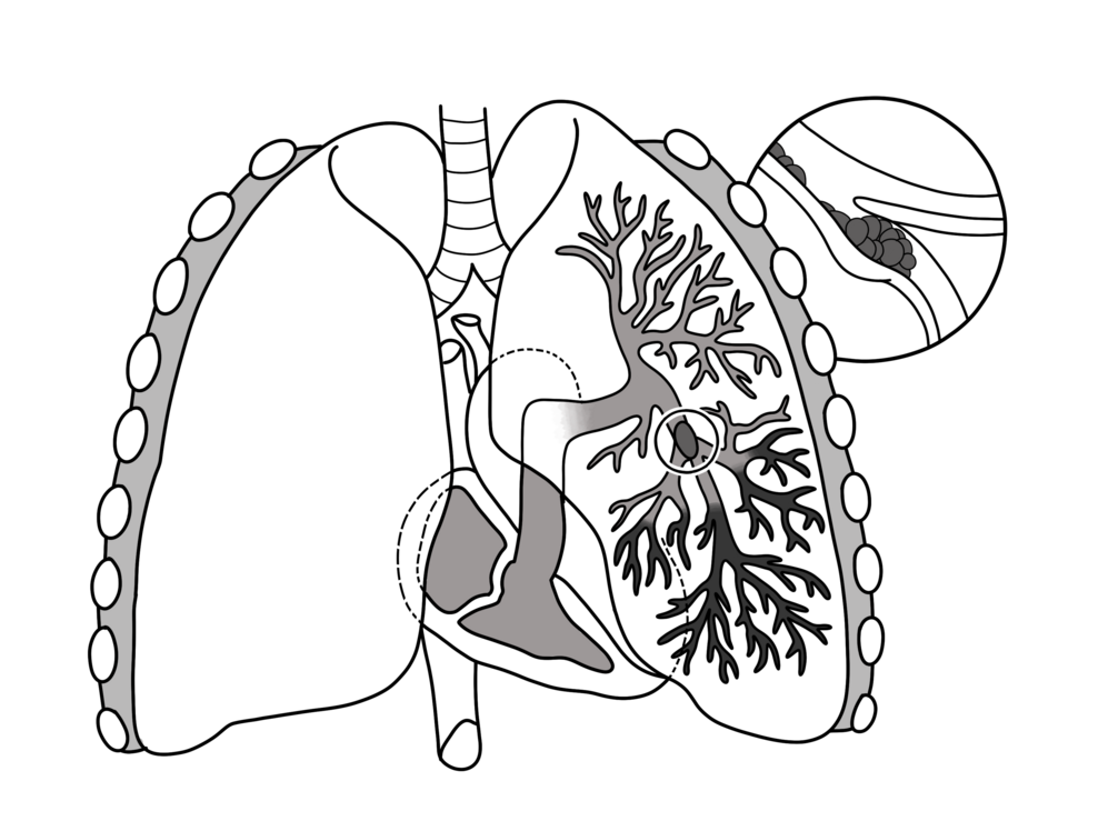 Pulmonary Embolism-avatar