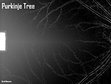 First-Person-Ansicht eines Purkinje-Baumes, während er in einer Spaltlampe/einem Biomikroskop sitzt