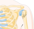 Shoulder fracture