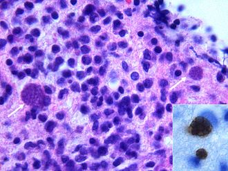 Toxoplasmose — Wikipédia