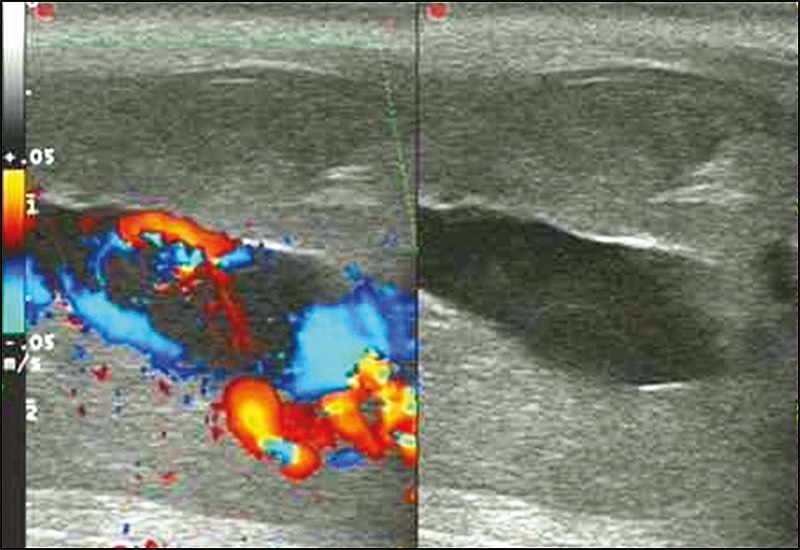 Plik:Ultrasonography of traumatic arteriovenous fistula of the penis.jpg