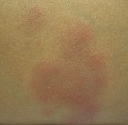 Erythema nodosum