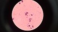 Body spots in Cold Ziehl-Neelsen stained slit skin smear.jpg