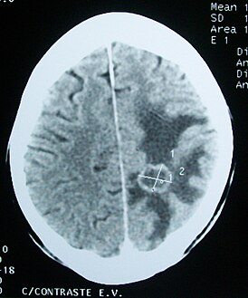 Edema da matéria cerebral (área escura) ao redor de um tumor metastático (tomografia computadorizada)