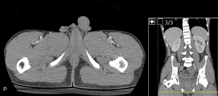 CT of a normal abdomen and pelvis, axial plane 302.png