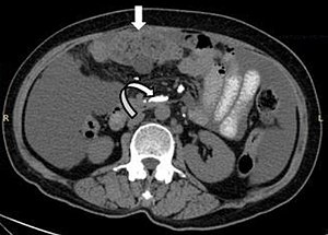 Fig. 11. A 52 year old female patient, a follow up case of mucinous cystadenocarcinoma ovary. Mixed solid and cystic peritoneal deposit (white arrow) with calcified mesenteric deposits (curved arrow) and ascites consistent with peritoneal carcinomatosis.[1]