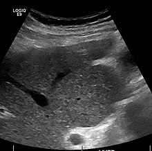 Caudate lobe hypertrophy on ultrasound due to cirrhosis Caudate lobe hypertrophy 0001.jpg