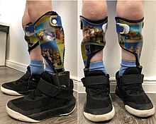 Child with cerebral palsy and orthotics with adjustable functional elements to improve safety when standing and walking Cerebralparese Orthese orthotics.jpg