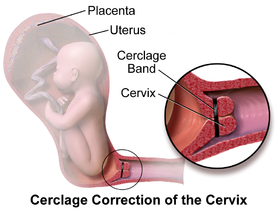 Tokeo la picha la CERVICAL INCOMPETENCE