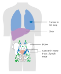 Thumbnail for File:Diagram showing advanced bladder cancer CRUK 441.svg