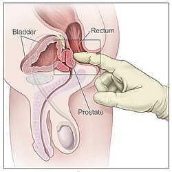 ipertrofia prostatica benigna psa