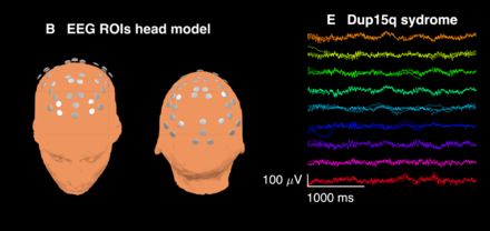 Diffuse beta waves present alongside other frequencies in spontaneous EEG recorded from a 28-month-old child with Dup15q syndrome.