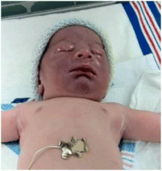 Facial duskiness due to tight nuchal cord