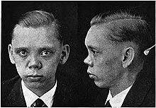 Saddle nose (congenital syphilis) Facies of Heredosyphilis 5.jpg