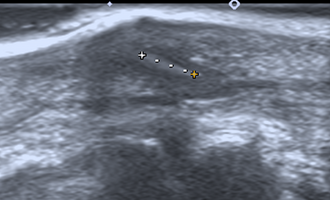 Ultrasonography of a subcutaneous splinter (in a finger) 4 x 1mm with oblique stroke. ForeignBody Ultras 1.png