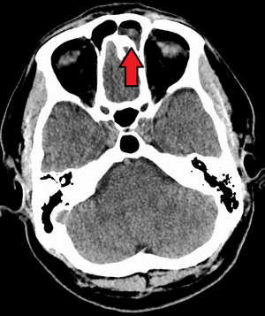 Sinusitis