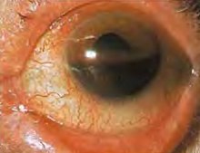 Hyphaema - showing blood filling the anterior chamber, causing a horizontal fluid level Hyphema - occupying half of anterior chamber of eye.jpg