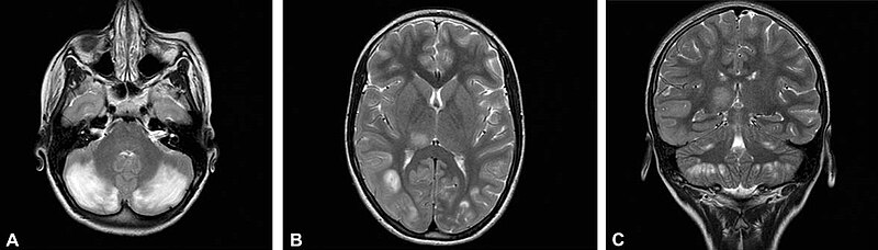 File:MRI of Cerebral Folate Deficiency in 12 yo girl with Dihydropyridine Reductase Deficiency - before treatment horizontal version.jpg