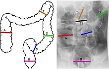 The diameters of different segments of the large intestine can be compared to the width of lumbar vertebra 2 for more consistent reference ranges on abdominal x-rays. Main measuring sites of colon diameter.jpg