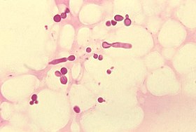 Malassezia furfur em pele de um paciente com tinha versicolor