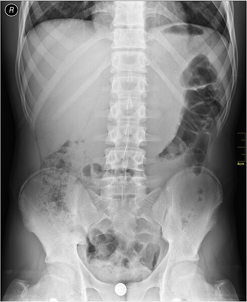 File:Medical X-Ray imaging PTZ06 nevit.jpg