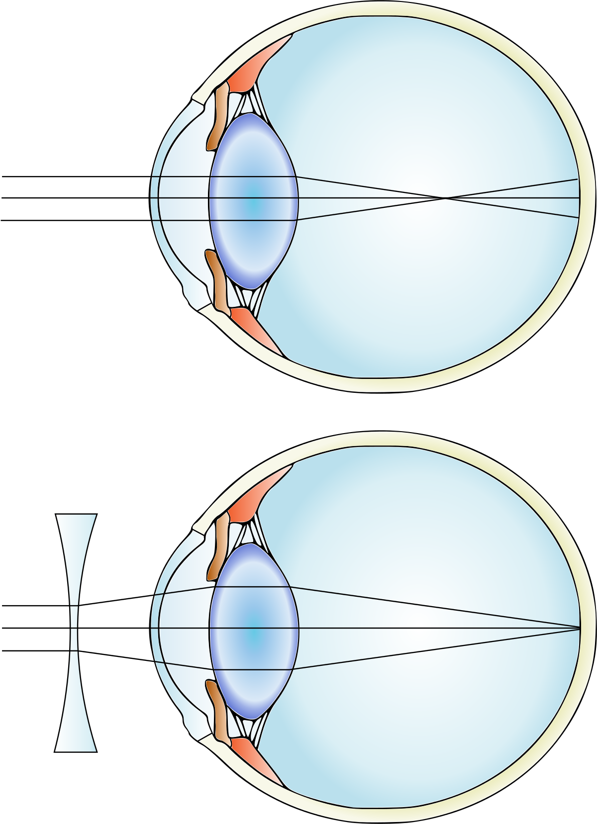 Retina miopia magna. dilatarea pupilei