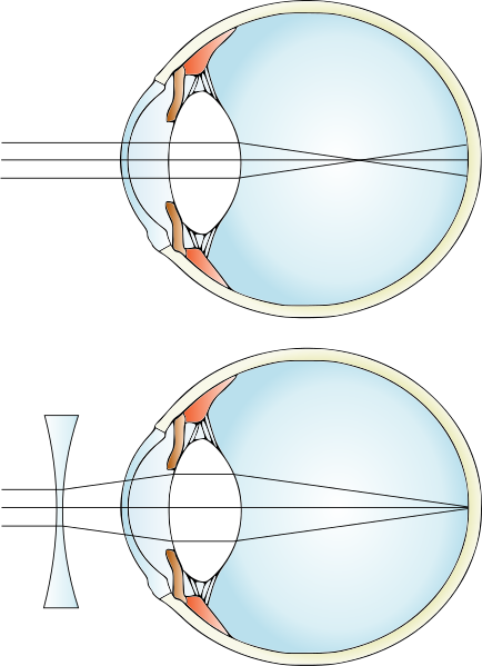 File:Myopia and lens correction.svg