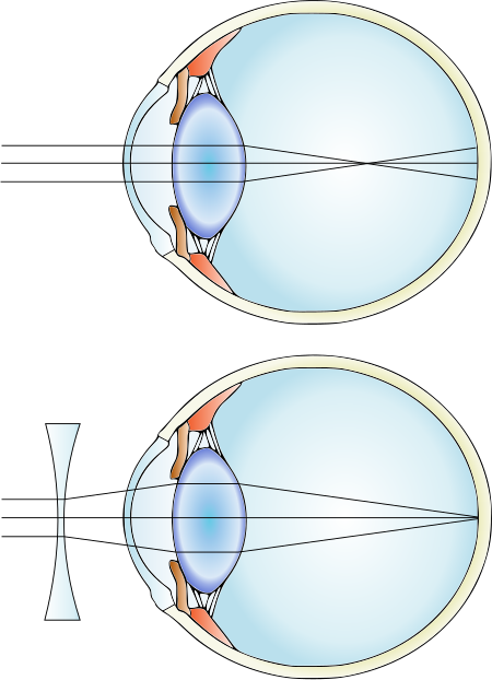 ไฟล์:Myopia_and_lens_correction.svg