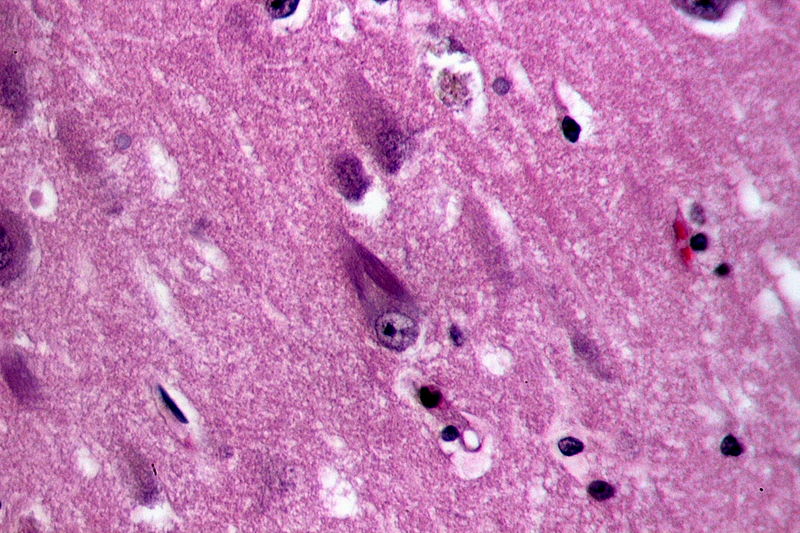 File:Neurofibrillary tangles in the Hippocampus of an old person with Alzheimer-related pathology, HE 2.JPG