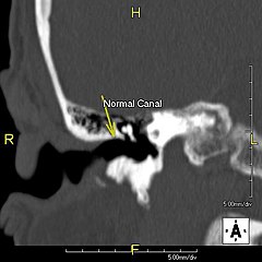 Conduit auditif normal