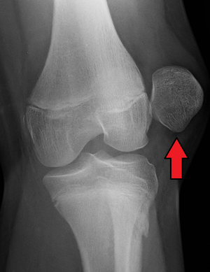 floating kneecap in humans