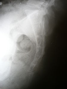 Lateral radiograph showing a fracture of the coccyx, as well as a lower lumbar fracture