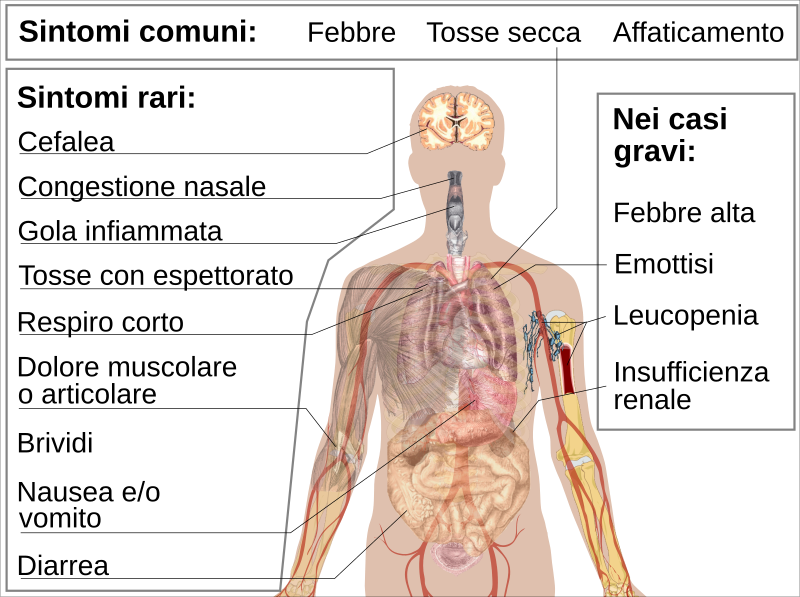 File:Symptoms of coronavirus disease 2019 2.0-IT.svg