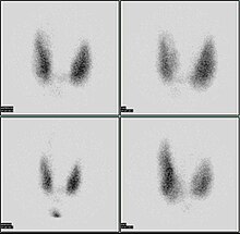 Thyroid scan Thyroid scan.jpg