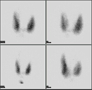 <span class="mw-page-title-main">Radioactive iodine uptake test</span>