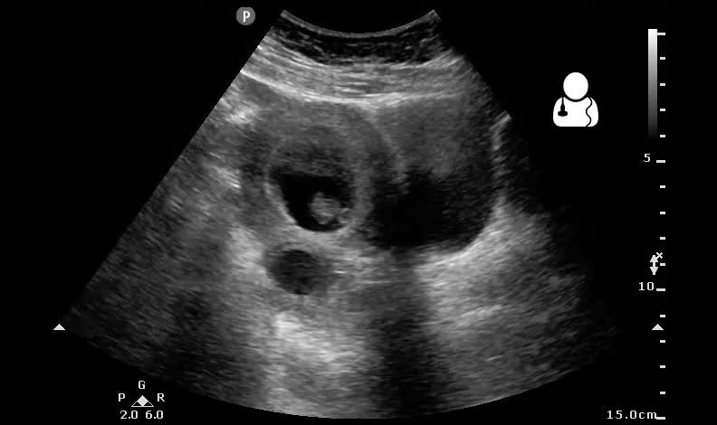 ectopic pregnancy ultrasound