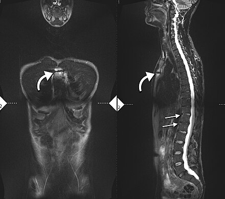 34-year-old male with AS