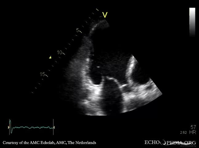 File:Apical aneurysm of LV E00285 (CardioNetworks ECHOpedia).webm - Wikimedia Commons